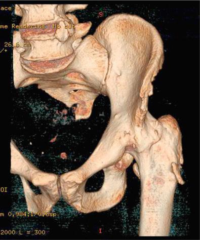 Fig. 83.2, Example of a 3-dimensional computed tomography scan of an arthrodesed hip. This is helpful for identifying bone landmarks encountered at surgery.