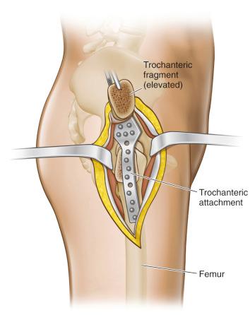 Fig. 83.3, Illustration of a hip exposure using a classic trochanteric osteotomy elevating the trochanter off of a Cobra plate. The trochanter is reflected superiorly to the left and is held with a clamp, exposing the Cobra plate lying on the lower ilium above the acetabulum. The trochanteric bed is also seen over the Cobra plate because the trochanter had been fixed over the plate at the time of fusion.