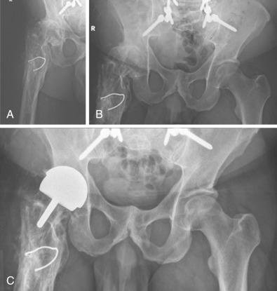 Fig. 78.1, Radiographs of a 42-year-old patient with proximal femoral deformity and severe posttraumatic osteoarthritis of the right hip who presented with disabling right hip pain and difficulties ambulating with a cane. Owing to femoral canal stenosis and femoral shaft misalignment, a hip resurfacing procedure was performed. (A,B) Preoperative anteroposterior (AP) right hip and pelvic radiographs. (C) Postoperative AP pelvic radiograph.