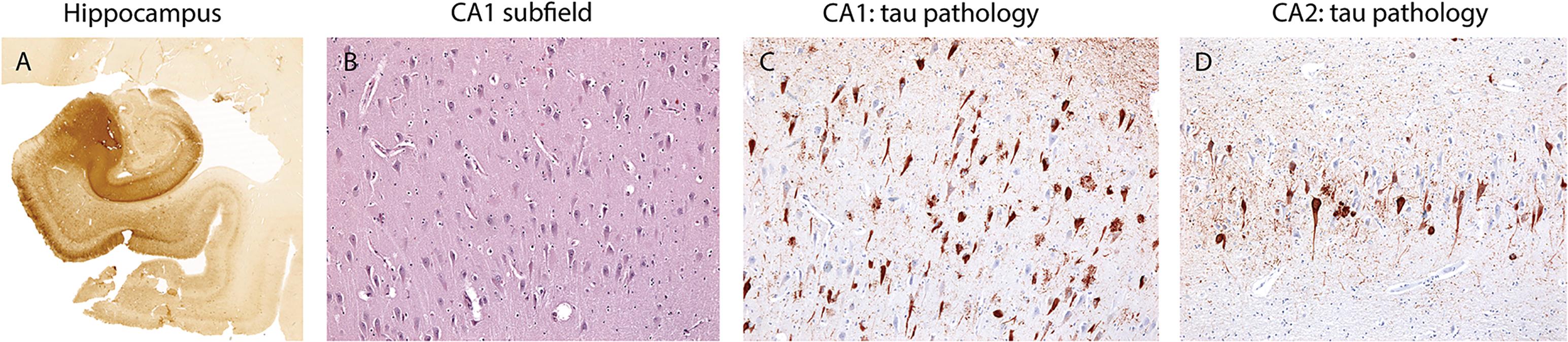 Fig. 5.1, Primary age-related tauopathy (PART). A patient with PART showing severe tau pathology within the hippocampus without beta-amyloid plaque deposition. A low-power view demonstrates tau pathology within the parahippocampal gyrus, subiculum, and hippocampus (A) . There is moderate loss of neurons within the CA1 subfield ( B , Luxol fast blue/hematoxylin and eosin stain). Tau pathology immunostaining shows numerous neurofibrillary pretangles and tangles in CA1 (C) and CA2 (D) with relative sparing of CA3 and CA4. Magnification: A , ~8×; B–C , B–D ,