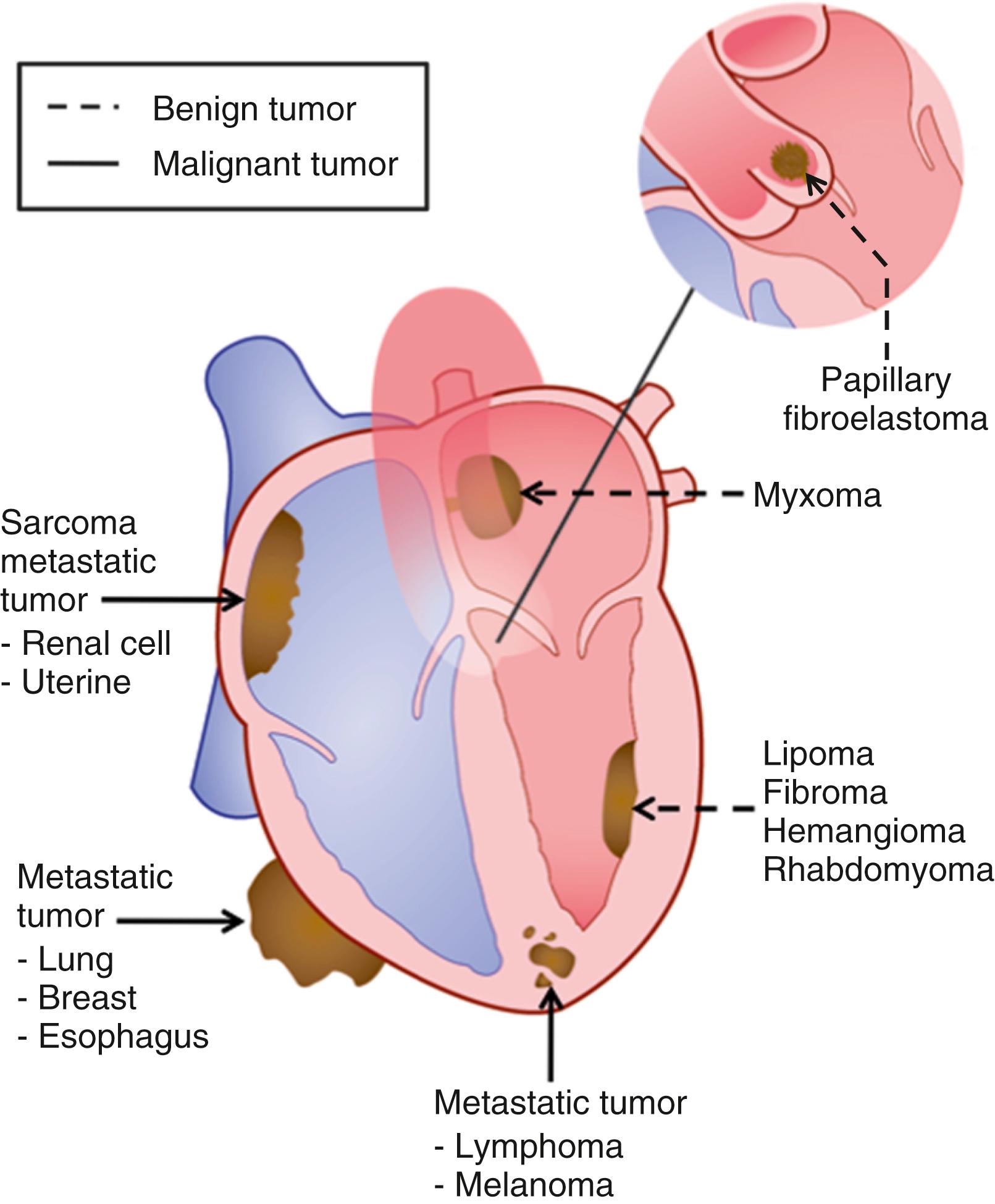 Figure 125.1, Schematic of the typical locations for common benign, malignant, and metastatic tumors in the heart.