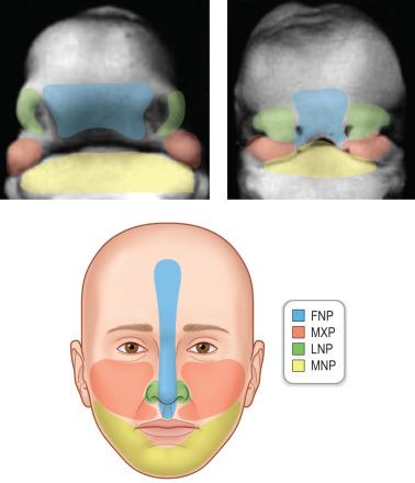 FIG. 3.2.2, Prominences of the vertebrate face. Frontonasal prominence (FNP), which contributes to the forehead, middle of the nose, philtrum, and primary palate; maxillary prominence (MXP), which contributes to the sides of the face and lip and the secondary palate; lateral nasal prominences (LNP), which form the sides of the nose; and the mandibular prominence (MNP), which produces the lower jaw.