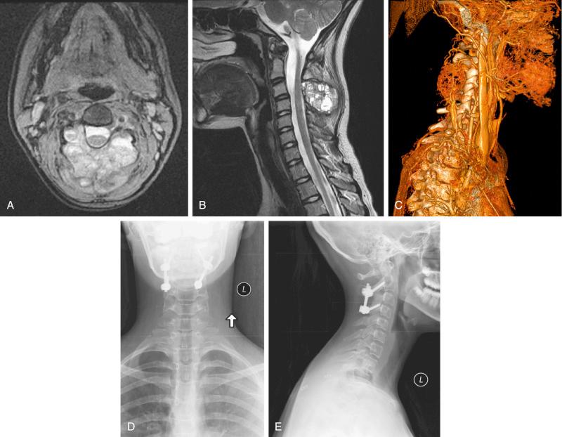 FIGURE 23-1, Axial ( A ) and sagittal ( B ) magnetic resonance imaging of an 11-year-old girl who presented with an expansile, painful posterior neck mass. The images revealed a large mass originating from the posterior elements of C3 with soft tissue expansion and fluid-fluid levels consistent with an aneurysmal bone cyst. C, Computed tomography angiography revealed the extremely vascular nature of the tumor with large feeding vessels. Her symptoms failed to improve following two embolization procedures, and surgical excision and stabilization from C2 to C4 were performed. Postoperative anteroposterior ( D ) and lateral ( E ) radiographs are shown.