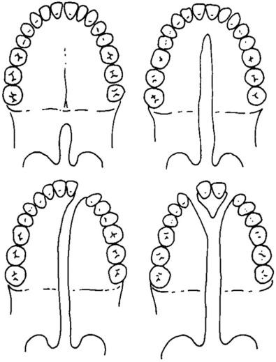 FIG. 3.4.1, Veau Classification of Cleft Palates.
