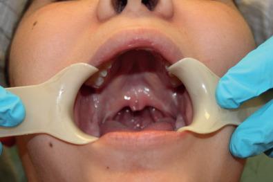 FIG. 3.4.2, Submucous Cleft Palate.