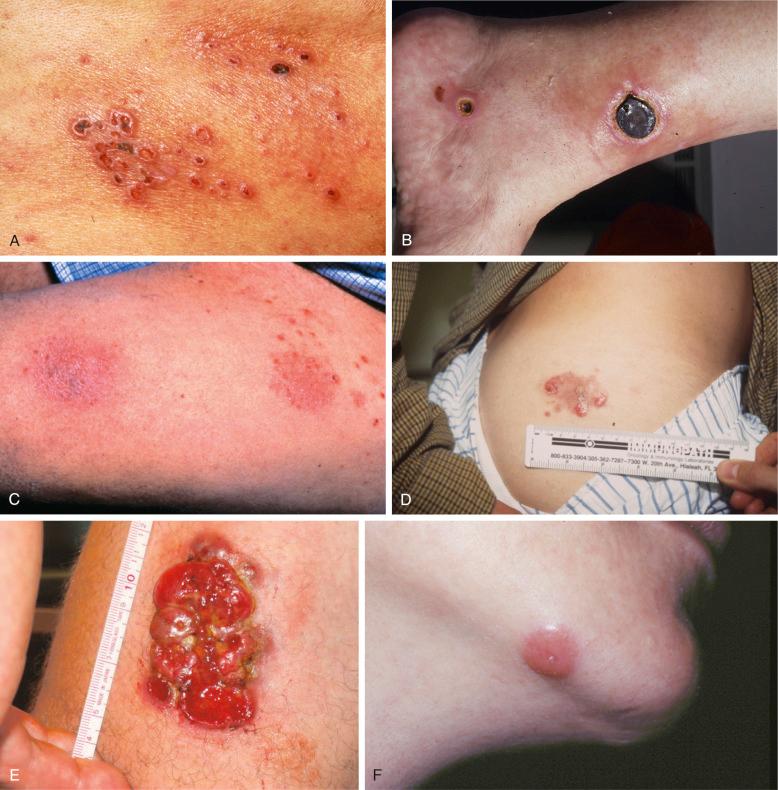 Figure 40-1, Clinical appearance of skin lesions in CD30 + cutaneous lymphoproliferative diseases.