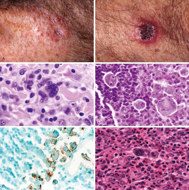 Figure 40-2, CD30 + T-cell lymphoproliferative disease and malignant lymphoma in a lymph node.