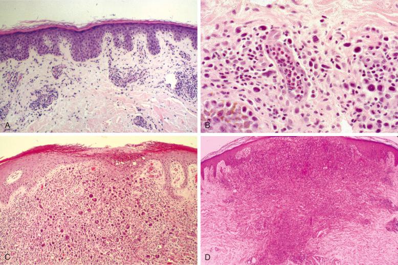 Figure 40-4, Histology of lymphomatoid papulosis (LyP).