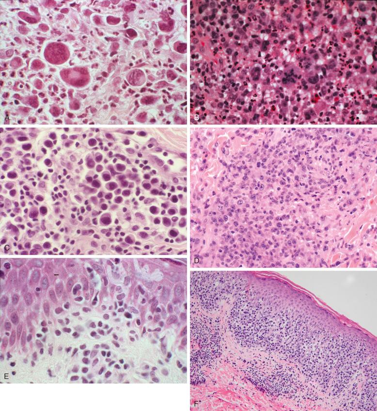 Figure 40-5, A, LyP type A with Reed-Sternberg–like cells surrounded by inflammatory cells. Apoptotic bodies are present. B, Minority of large, atypical cells and abnormal mitosis surrounded by numerous neutrophils and eosinophils in LyP. C, LyP cells with plasmacytoid morphology. D, LyP type C with sheets of large cells in the dermis. E, LyP type B with epidermotropic cerebriform cells. F, LyP type D with pagetoid infiltration of epidermis. G, LyP type E with angioinvasive lymphoid infiltrate. H, LyP with 6p25.3 gene rearrangement. Note biphasic morphology with small irregular epidermotropic lymphocytes and admixture of larger cells with pale nuclei in dermis.