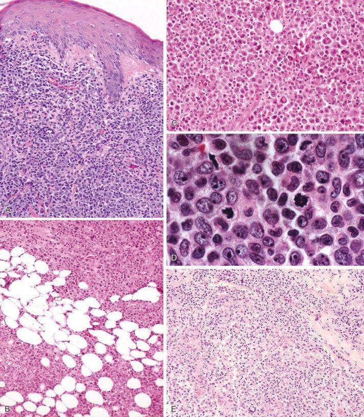 Figure 40-6, Histology of CD30 + cutaneous anaplastic large cell lymphoma (C-ALCL).