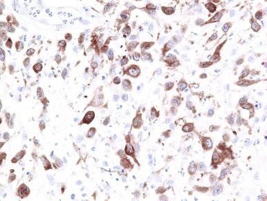 Figure 40-8, Cytoplasmic variant of anaplastic lymphoma kinase (ALK) in cutaneous anaplastic large cell lymphoma. Note the absence of staining over the nuclei of tumor cells. ALK was confirmed to be activated (phosphorylated) in this case.