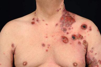 Figure 41-1, Primary cutaneous aggressive epidermotropic CD8 + cytotoxic T-cell lymphoma.