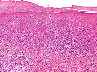 Figure 41-2, Primary cutaneous aggressive epidermotropic CD8 + cytotoxic T-cell lymphoma.