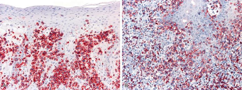 Figure 41-3, Primary cutaneous aggressive epidermotropic CD8 + cytotoxic T-cell lymphoma.