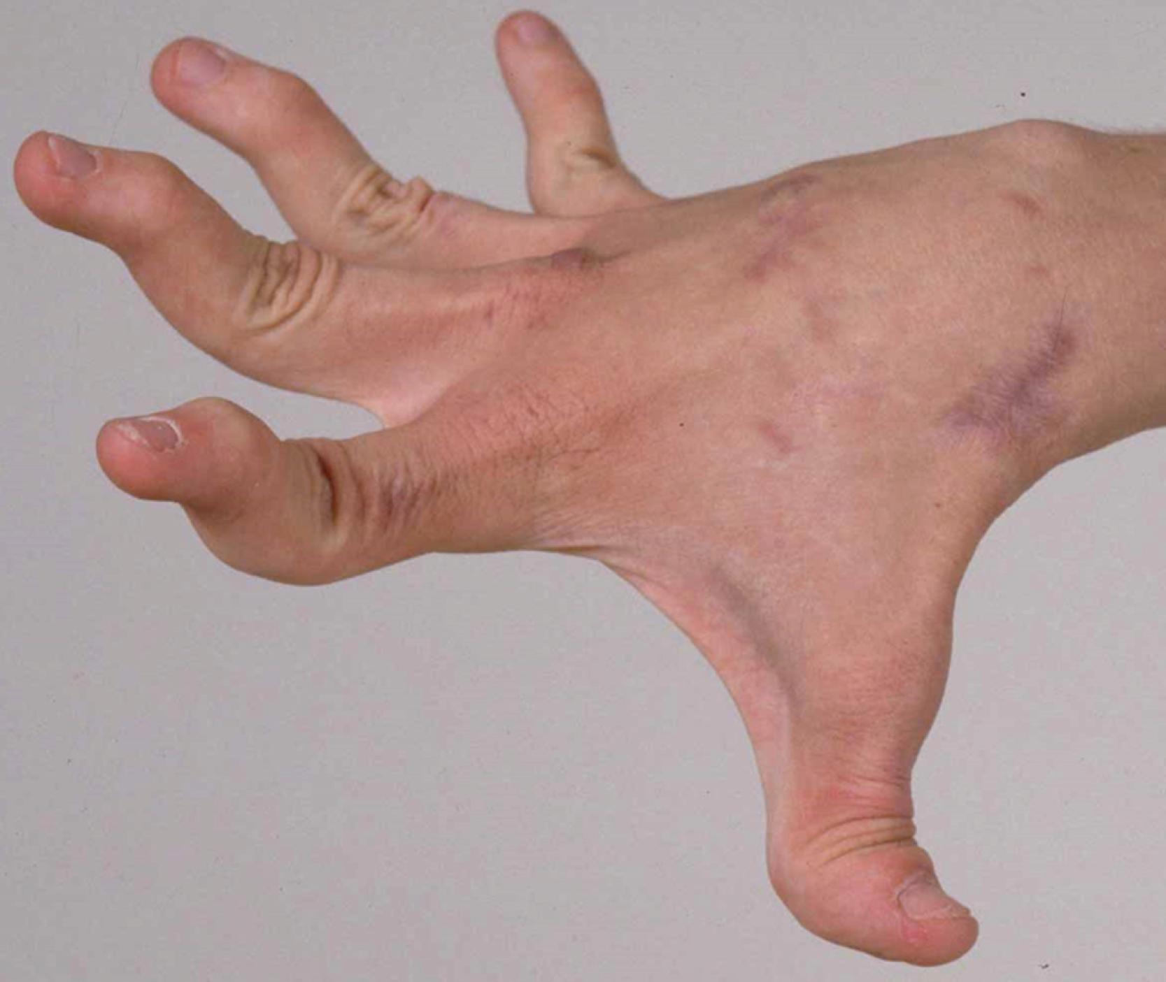 Fig. 54.1, Clinical photograph of the hand of an adult with classical Ehlers–Danlos syndrome. The joints are hypermobile and the skin is thin and hyperextensible and has multiple poorly healed scars.