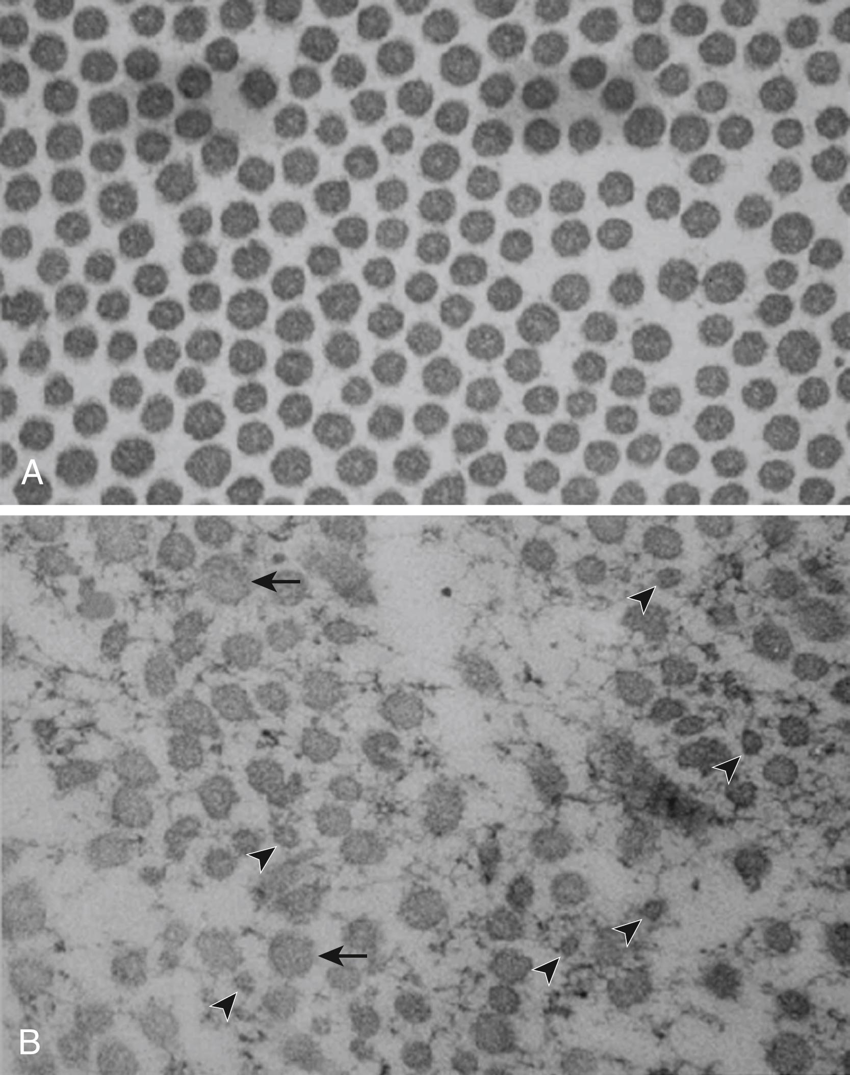 Fig. 54.2, Transmission electron microscopy of the dermis of the volar aspect of the forearm of the same patient with classical Ehlers–Danlos syndrome shown in Fig. 54.1. A, Normal appearance of regular and uniform diameter collagen fibrils in an aged-matched control. B , Reduced number of collagen fibrils with abnormal shapes and sizes of the fibrils in the patient (abnormally small fibrils, arrowheads; abnormally large fibrils, arrows ).