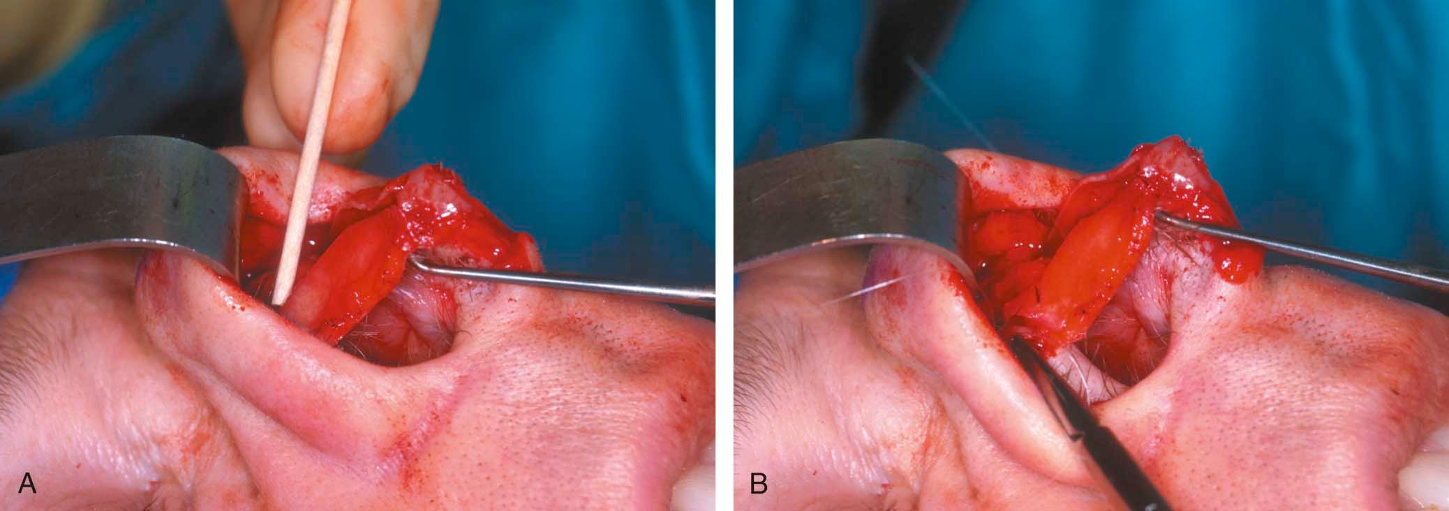 Figure 6-12, Lateral crura flap to increase rotation.