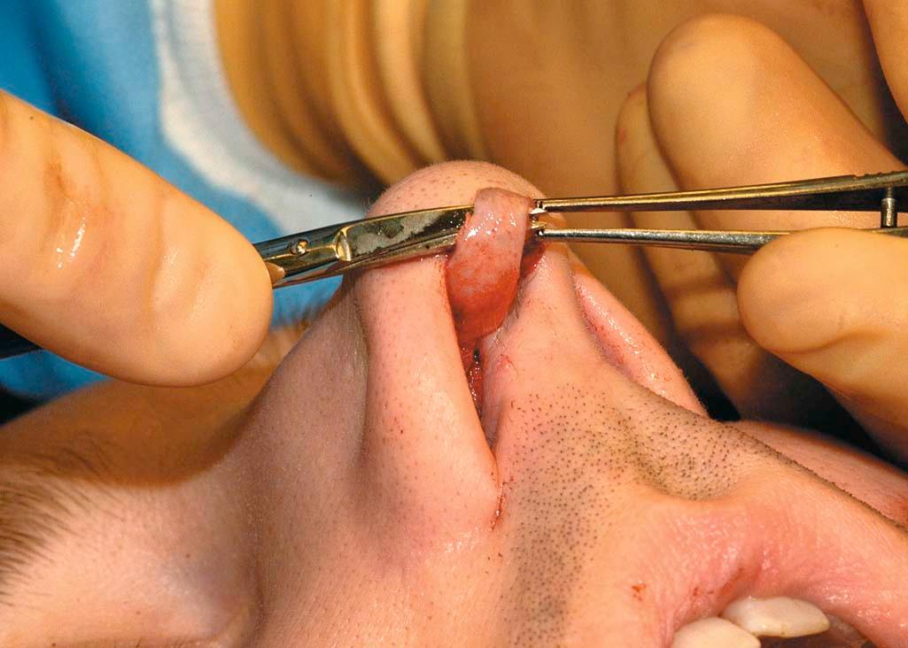 Figure 6-6, LLC/Dome separated from vestibular skin.