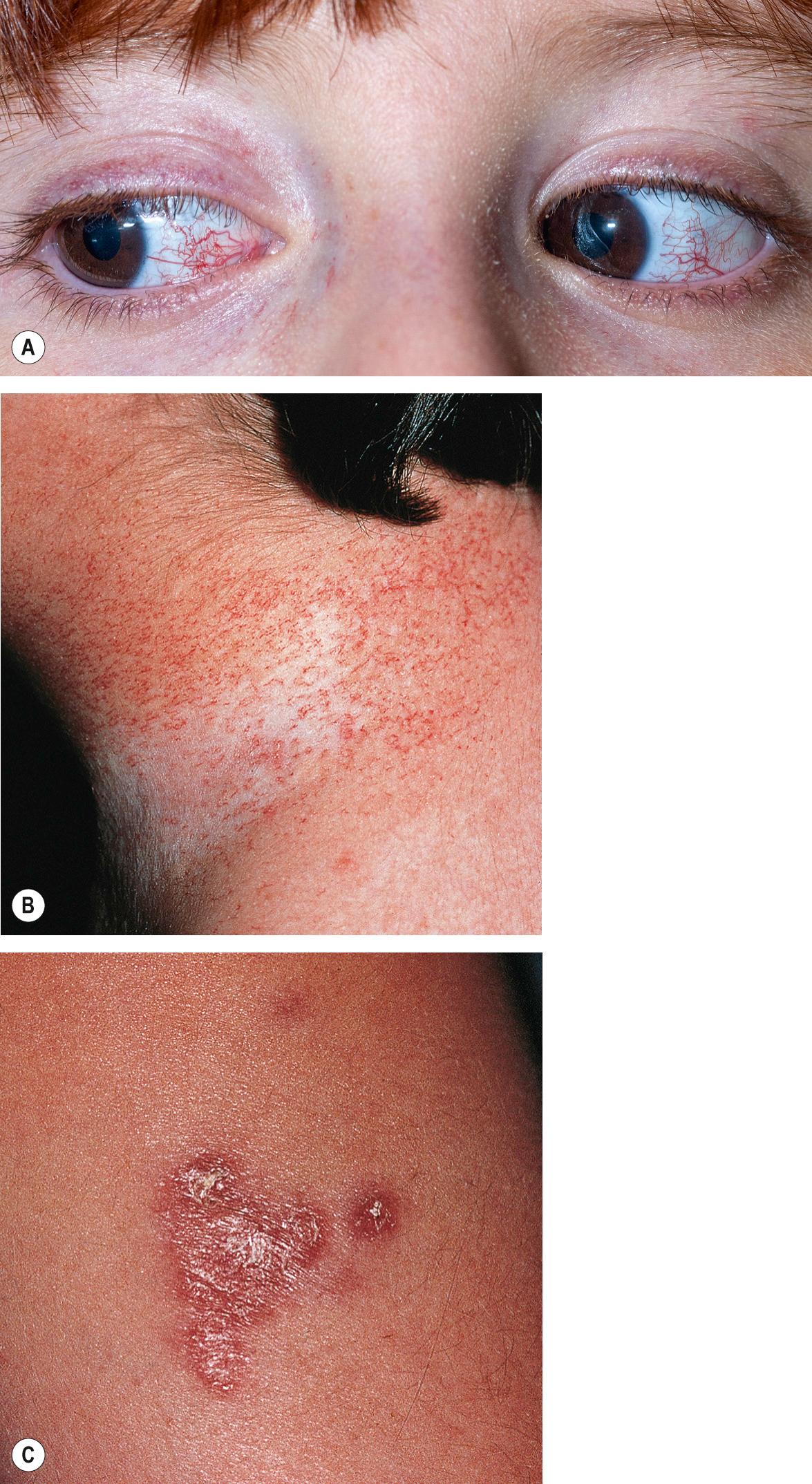 Fig. 60.1, Ataxia–telangiectasia (AT).