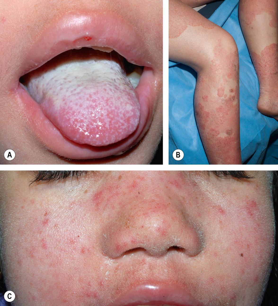 Fig. 60.3, Chronic mucocutaneous candidiasis and dermatophytosis due to increased STAT1 signaling.