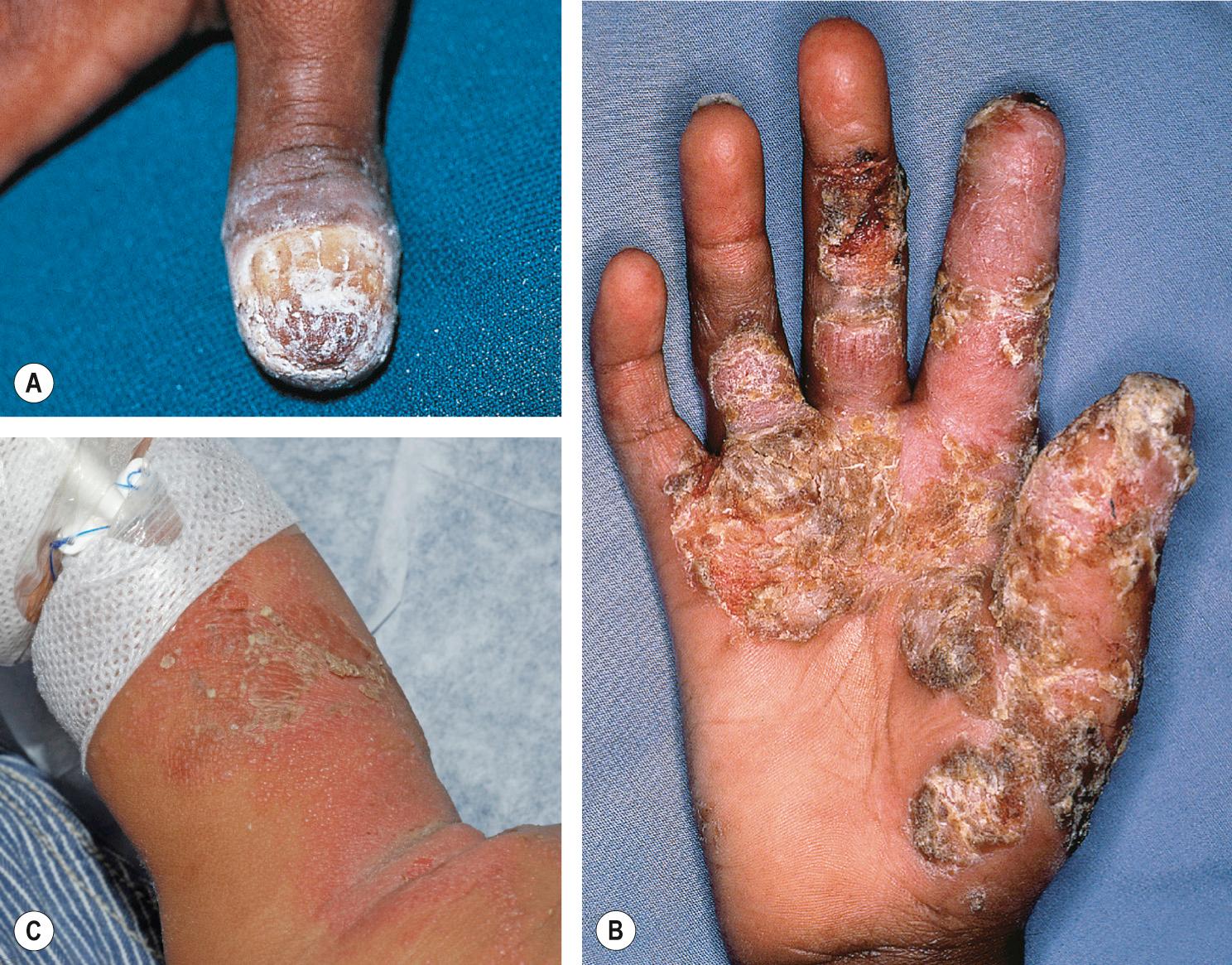 Fig. 60.4, Chronic mucocutaneous candidiasis.