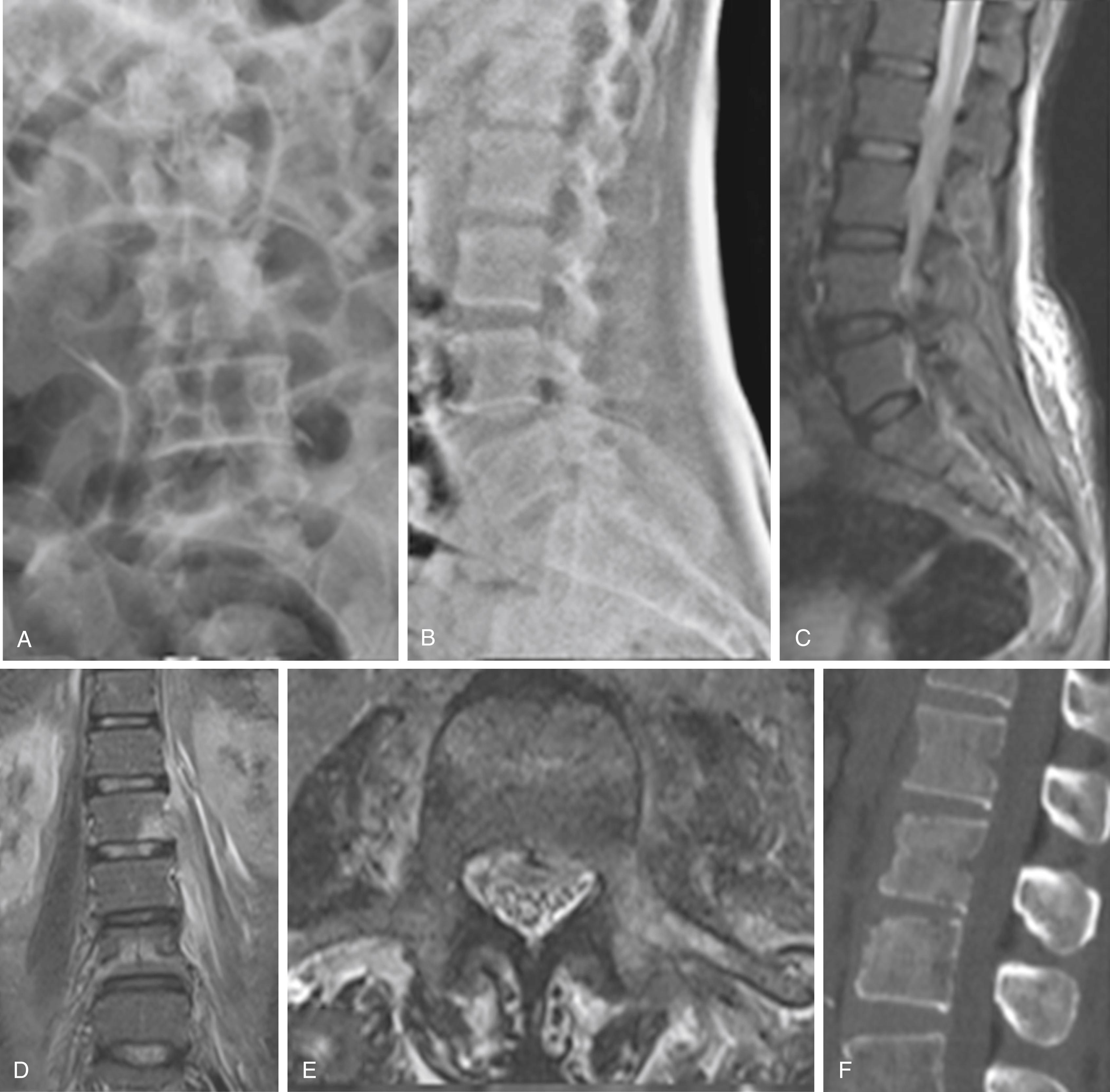 Fig. 44.1, Imaging findings in early spondylodiscitis. A and B, Anteroposterior and lateral plain radiographs with fairly normal anatomical structures. C to E, Midsagittal, coronal, and axial magnetic resonance imaging (at the level of pedicle) sections of T2-weighted sequences showing hyperintense L1–L2 and L2–L3 disc spaces and hyperintense marrow regions on the left L2 vertebral body extending to the left pedicle and transverse process, with some collection over the left psoas musculature. F, Midsagittal computed tomography sections showing some reduction in the L2–L3 disc space and osteopenia and focal lytic regions in the L1, L2, and L3 vertebrae.