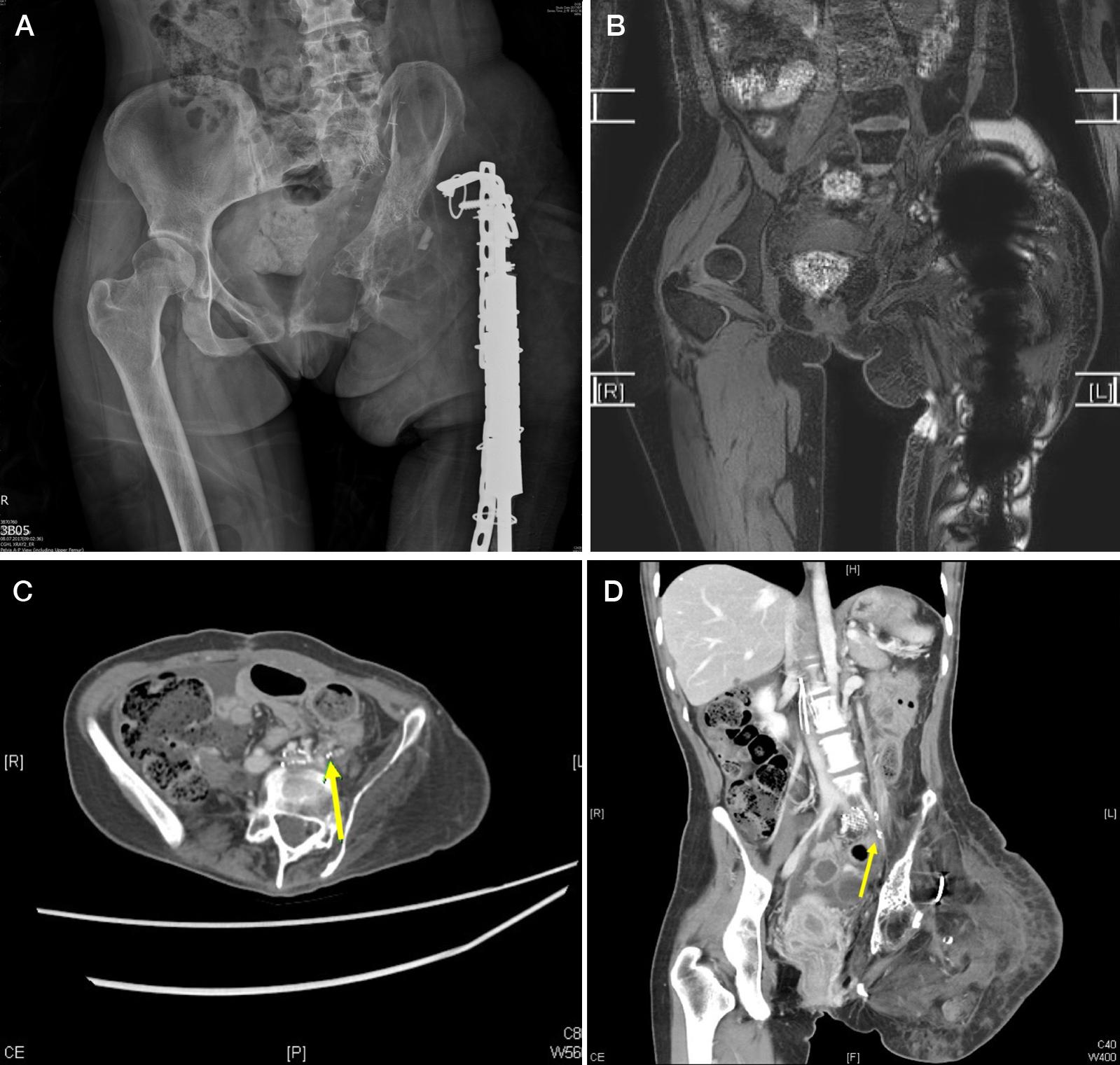 Fig. 5.1, Imaging Results of a Primary Extremity Lymphedema Patient with Retroperitoneal Lymphangiomatosis.