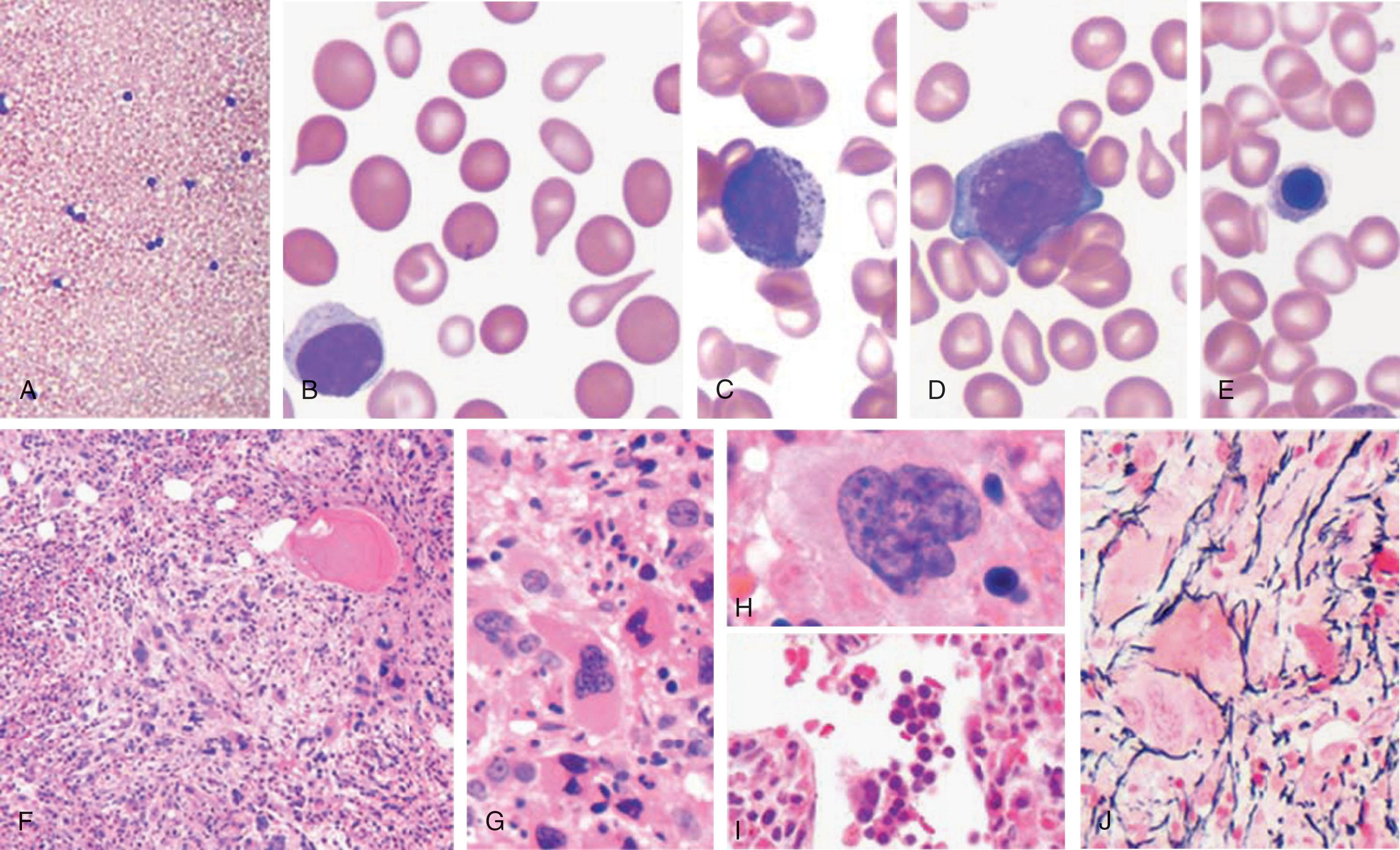 Figure 72.2, PRIMARY MYELOFIBROSIS.