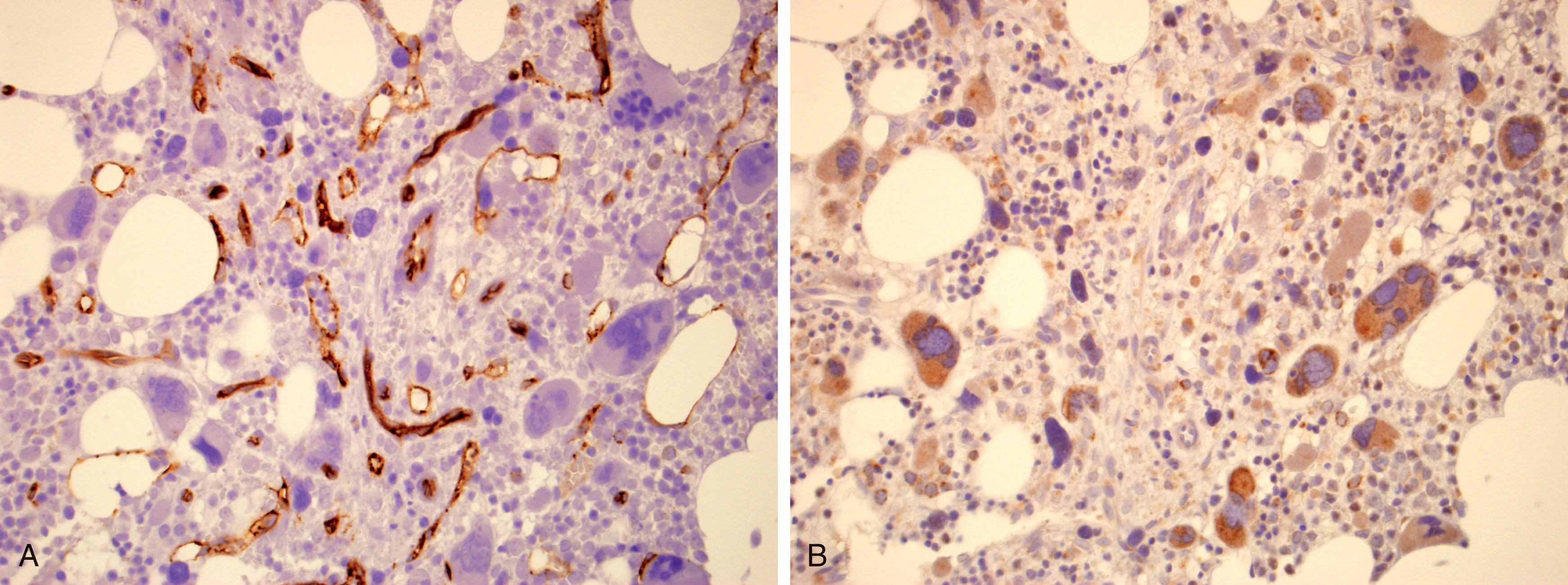 Figure 72.3, IMMUNOHISTOCHEMICAL STAIN OF BONE MARROW BIOPSY FROM A PATIENT WITH PRIMARY MYELOFIBROSIS.