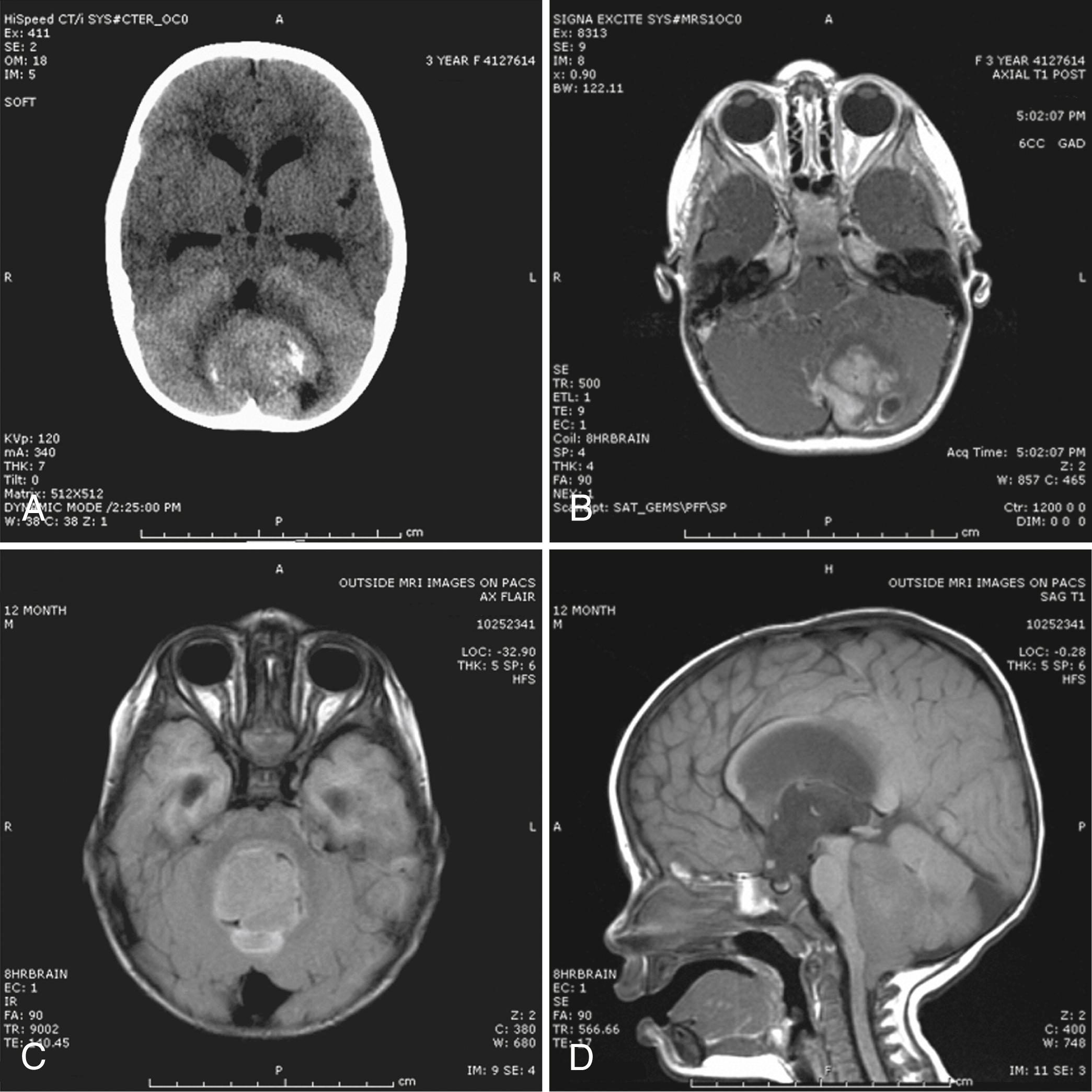 Fig. 75.1, A, A 3-year-old girl presented with 3 weeks of worsening headaches that awakened her at night. A contrast-enhanced cranial computed tomography (CT) scan shows a large dense mass within the posterior fossa, containing internal calcifications. Surrounding edema can be seen. Compression of the quadrigeminal plate cistern and fourth ventricle led to obstructive hydrocephalus. B, Axial T1 postcontrast magnetic resonance image (MRI) of the same patient, showing heterogeneous enhancement of the lesion. MR spectroscopy showed a markedly depressed N-acetylaspartate (NAA) peak, with elevation of the choline peak consistent with high-grade tumor. Diffusion-weighted imaging showed restricted diffusion indicative of a highly cellular lesion. Resection of the mass showed it to be a medulloblastoma. C, A 13-month-old child presented with unsteady gait and vomiting over several days. MRI showed a large nonenhancing posterior fossa mass filling the fourth ventricle. Resection showed tumor consistent with ependymoma. Axial T2 fluid-attenuated inversion recovery (FLAIR) image shows T2 prolongation. D, Sagittal T1 image showing the ependymoma filling the fourth ventricle. The lesion extends out of the foramen of Magendie over the dorsal surface of the cervical spinal cord.