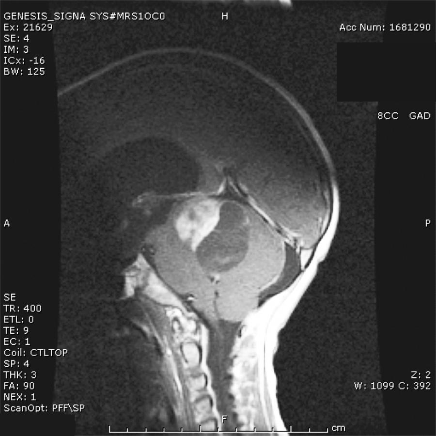 Fig. 75.2, A 9-year-old boy who presented with a short history of headache and nausea. Contrast-enhanced cranial magnetic resonance imaging was obtained because of the severity of his headaches, which demonstrated an enhancing tumor with a solid portion in the anterior aspect of the posterior fossa, adjacent to the dorsal midbrain. A large cyst can be seen posterior to the solid mass. Resection revealed a pilocytic astrocytoma.