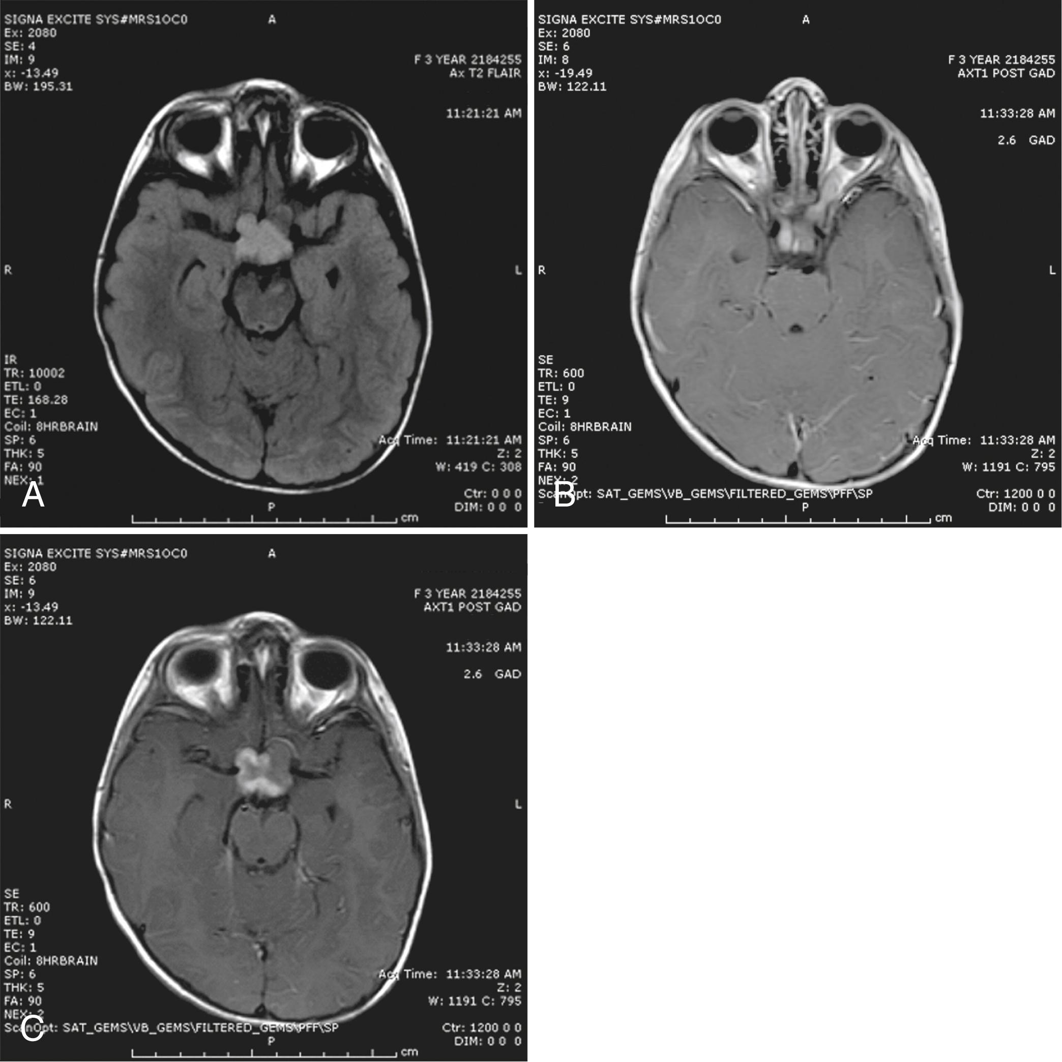 Fig. 75.3, A 3½-year-old girl with a history of neurofibromatosis type 1 (NF1) who was seen after an ophthalmological evaluation revealed a left eye deviation and visual-field loss. A, Magnetic resonance imaging (MRI) reveals T2 prolongation in the optic chiasm. B, There is significant enlargement of the left optic nerve. C, Coronal T1 postgadolinium imaging shows the lesion to be contrast enhancing. The combined findings were highly suggestive of an optic pathway glioma.