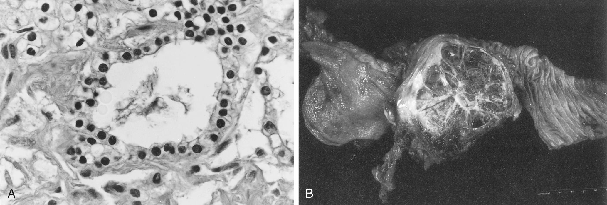 FIGURE 98.1, Serous cystadenoma of the pancreas (serous cystic neoplasm). (A) Simple serous cuboidal cells without dysplasia. (B) Gross appearance with multiple small cysts.