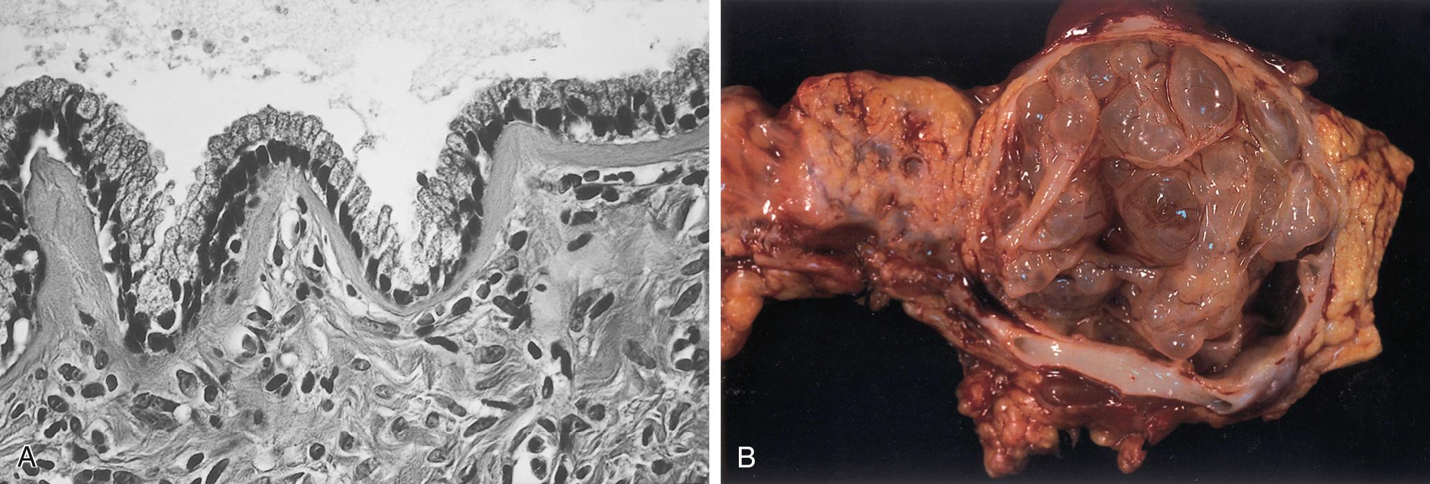 FIGURE 98.2, Mucinous cystic neoplasm of the pancreas. (A) Columnar mucinous cells line the cyst wall. (B) Gross appearance of macrocysts with thin walls and mucinous cystic fluid.