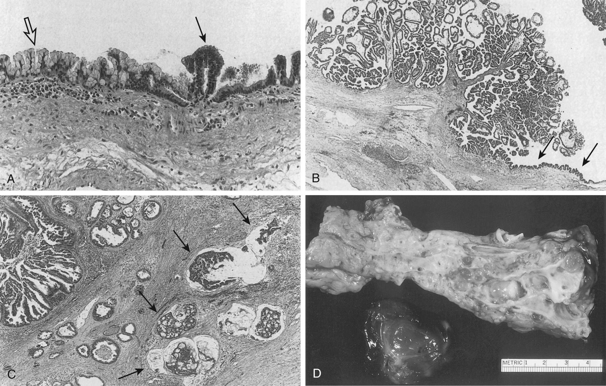 FIGURE 98.4, Intraductal papillary mucinous neoplasm. (A) Ductal epithelium containing nondysplastic, micropapillary mucinous hyperplasia (open arrow) and micropapillary dysplasia (solid arrow). (B) Gross papillomatous changes with changes of flat micropapillary dysplasia (arrows). (C) Invasive adenocarcinoma (arrows). (D) Gross findings; main pancreatic duct dilation with copious intraductal mucin and ductal adenomas.