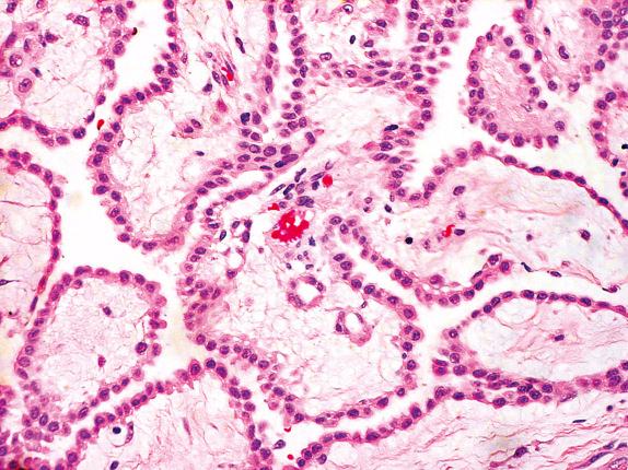 FIG. 32.11, Well-differentiated papillary mesothelioma. Well-developed fibrovascular cores are lined by a single layer of low-grade cuboidal tumor cells.