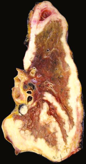 FIG. 32.2, Pleural mesothelioma, late stage. This advanced mesothelioma demonstrates diffuse pleural growth, circumferential encasement of lung, extension along fissures, and hilar lymph node metastases.