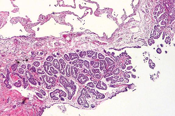 FIG. 32.3, Epithelioid mesothelioma. This tumor shows invasive pseudoacinar architecture at the pleural surface.