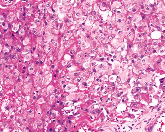 FIG. 32.4, Malignant mesothelioma, epithelioid variant (deciduoid subtype). Sheets of large, round cells with abundant cytoplasm, paracentric nuclei, and prominent nucleoli are typical of this tumor.