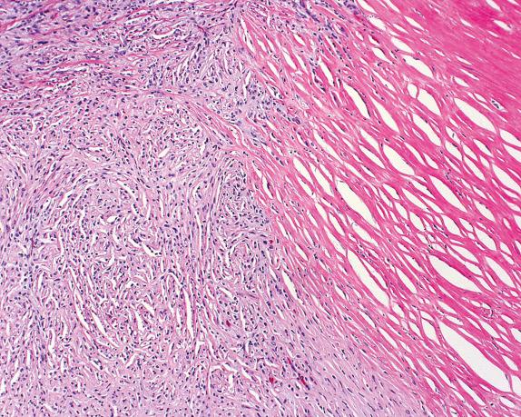 FIG. 32.5, Sarcomatoid mesothelioma. The sarcomatous spindle cell proliferation invades a pleural plaque.