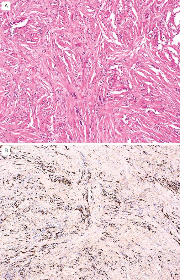 FIG. 32.7, Desmoplastic mesothelioma. The “patternless” growth pattern of these cytologically bland tumor cells in hyalinized stroma is characteristic of this neoplasm (A), as is immunoreactivity with anticytokeratin (B).
