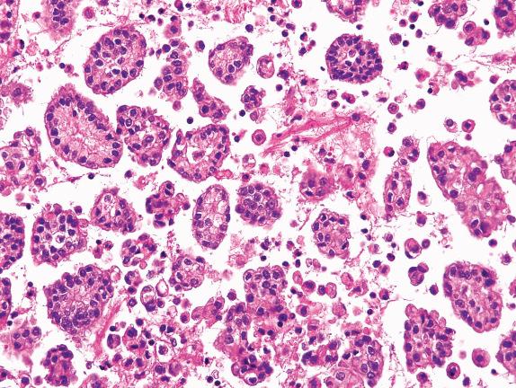 FIG. 32.8, Malignant mesothelioma, epithelioid, in pleural fluid. This fluid contains a mixture of papillary groups, clusters, and individual polygonal cells with relatively mild cytologic atypia.