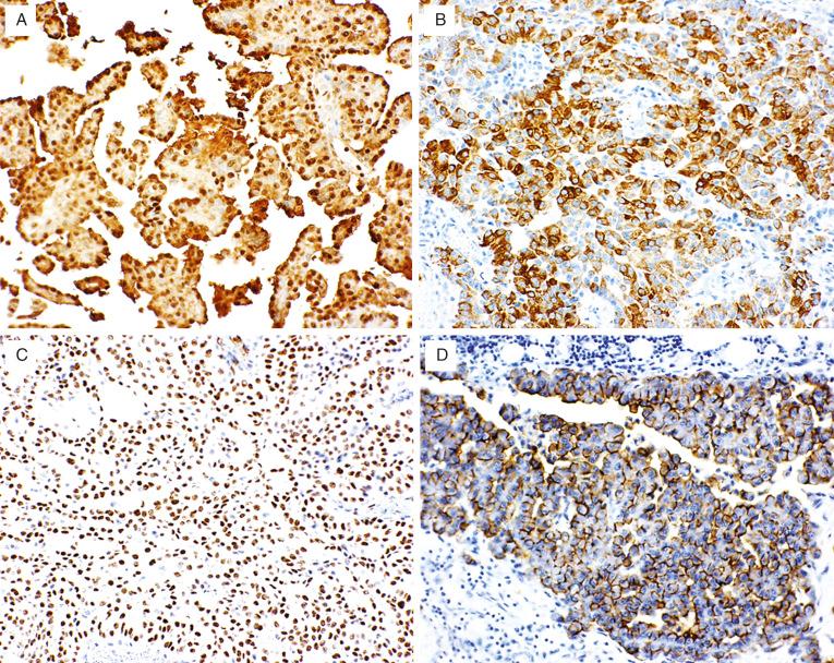 FIG. 32.9, Malignant mesothelioma. Shown are representative examples of immunohistochemistry for (A) calretinin, (B) cytokeratin 5/6, (C) Wilms tumor-1, and (D) D2-40.