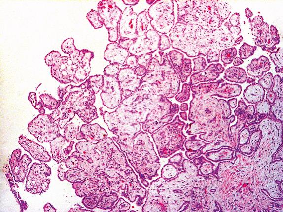 FIG. 32.10, Well-differentiated papillary mesothelioma. This tumor displays exophytic growth and no stromal invasion.