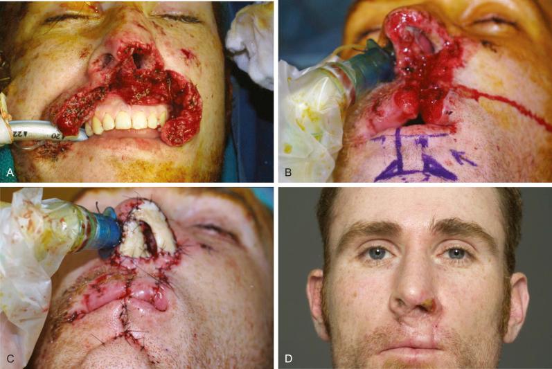 Fig. 1.4.3, (A) Traumatic avulsion of the upper lip and nose resulting from a dog bite. (B) True defect after repositioning of the residual subunits with planned lip switch flap. (C) Immediate postoperative picture with lip switch flap reconstruction of the lower lip and nasal sill, full-thickness skin graft of the columella and helical rim composite graft to the alar rim. (D) Early postoperative result following division of the lip switch flap.
