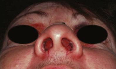 Fig. 1.4.5, Septal hematoma following nasal trauma. Note the bulging ecchymotic mucosa causing bilateral nasal obstruction.