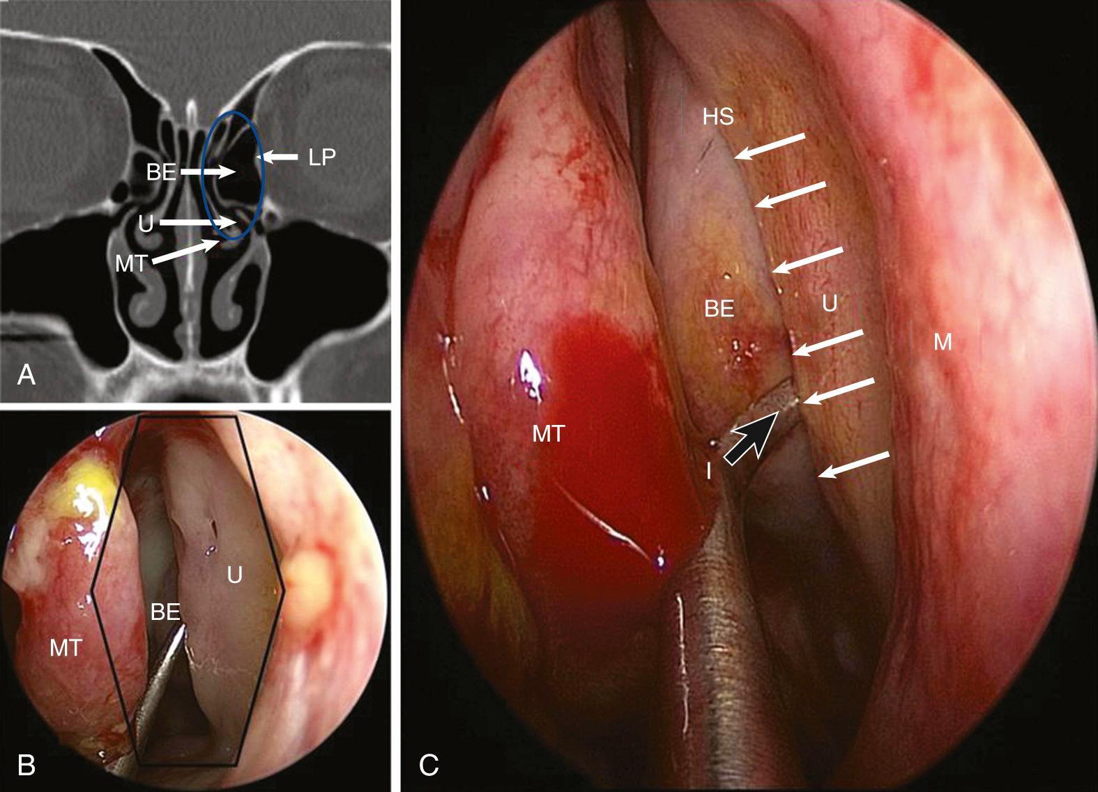 Fig. 44.1, Left ostiomeatal complex (enclosed by blue circle ) is bound laterally by the medial orbital wall or lamina papyracea (LP) and medially by the middle turbinate (MT) . BE , bulla ethmoidalis; U , uncinate process. (A) Coronal CT section outlining ostiomeatal complex boundaries. (B) Endoscopic view of left nasal cavity with the middle turbinate being medialized. (C) Closer view of the left middle meatus. The uncinate process extends anteriorly to the anterior maxillary line (M) . Its posterior free margin parallels the ethmoidal bulla. The hiatus semilunaris (HS, white arrows) is a two-dimensional cleft between the posterior free edge of the uncinate and the ethmoidal bulla. It is the gap through which the nasal cavity communicates with the ethmoidal infundibulum (I). The infundibulum (black arrow) is a three-dimensional space between the uncinate process and lamina papyracea. This endoscopic figure shows the maxillary ball probe being passed through the linear hiatus semilunaris into the infundibulum.