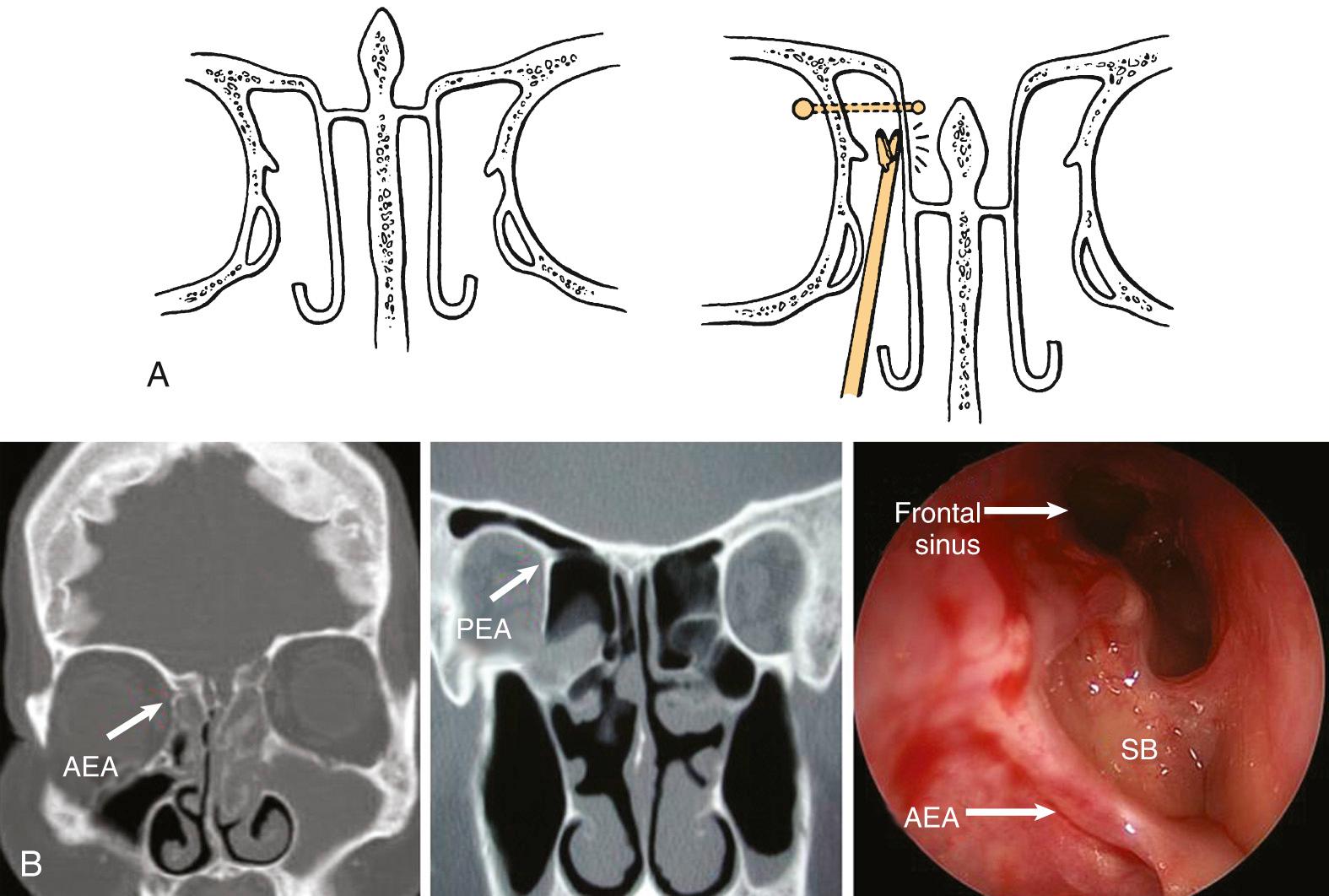 Fig. 44.12, (A) Dissection should be avoided along the medial aspect of the middle turbinate, because the roof of the ethmoid may lie higher than the cribriform plate. Left, Shallow cribriform–fovea ethmoidalis complex. Right, Low-lying cribriform plate with long lateral lamella. Instrument points to the most common area of iatrogenic cerebrospinal fluid leak. (B) The location of the ethmoidal arteries must be determined prior to skull base (SB) dissection. On a computed tomography scan, these arteries appear as conical projections from the orbit and may sometimes lie within the ethmoidal space, pedicled (outside the SB ). The anterior ethmoidal artery (AEA) is located in the skull base just posterior to the frontal sinus recess. The posterior ethmoidal artery (PEA) is located just anterior to the sphenoid in the larger-appearing posterior ethmoidal cells.