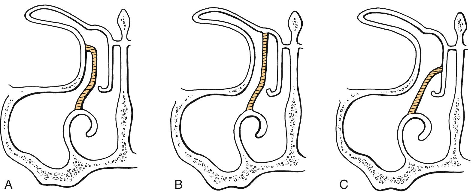 Fig. 44.2, Coronal schematic view of the ostiomeatal complex showing the superior attachments of the uncinate process to the lamina papyracea (A), the roof of the ethmoidal complex (B), or the middle turbinate (C). If the uncinate process attaches to the roof of the ethmoid or to the middle turbinate, the frontal sinus drains into the infundibulum. If the uncinate attaches to the lamina papyracea, the frontal sinus drains medially, next to the middle turbinate.