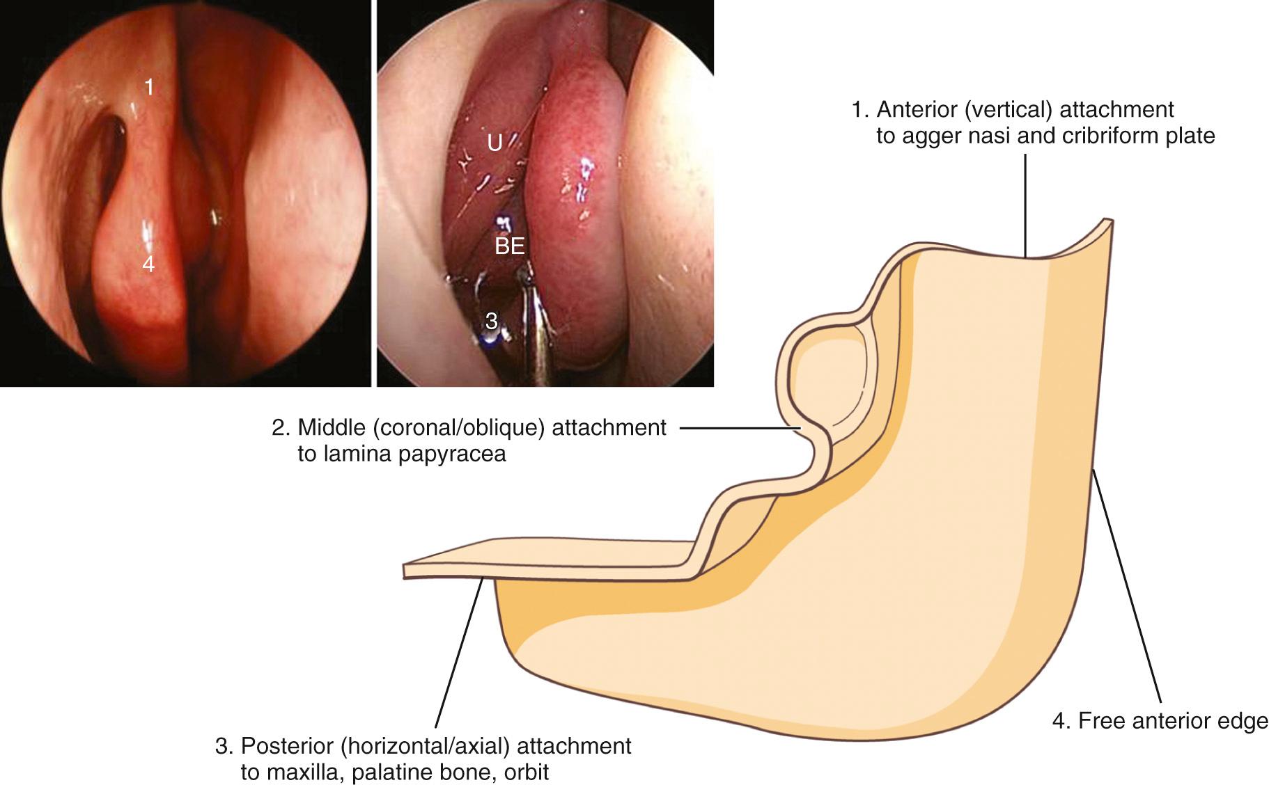 Fig. 44.3, Schematic view of the right middle turbinate viewed from the lateral aspect illustrates the anterior vertical (1), middle oblique (2), and posterior horizontal (3) attachments. Inset, endoscopic views of the right middle turbinate show the free anterior edge (4) and the anterior (1) and posterior (3) attachments. U, uncinate; BE, bulla ethmoidalis.